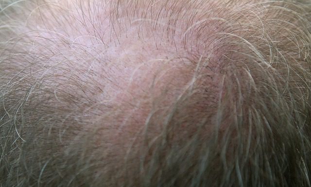 שיטות השתלות שיער קיימות: ההבדלים בין שיטת FUE לשיטת DHI