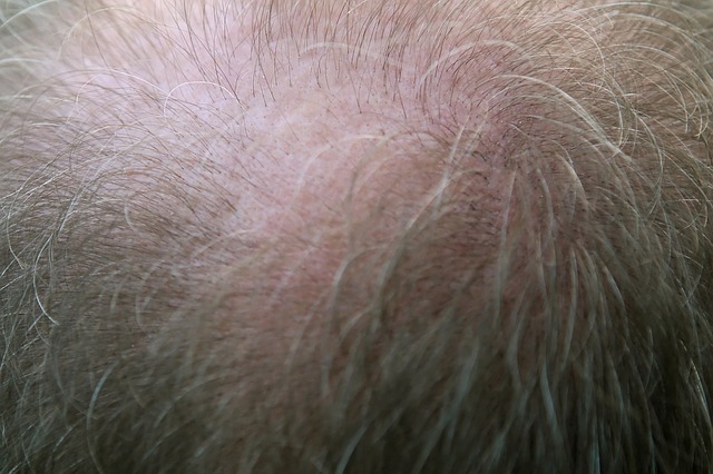שיטות השתלות שיער קיימות: ההבדלים בין שיטת FUE לשיטת DHI